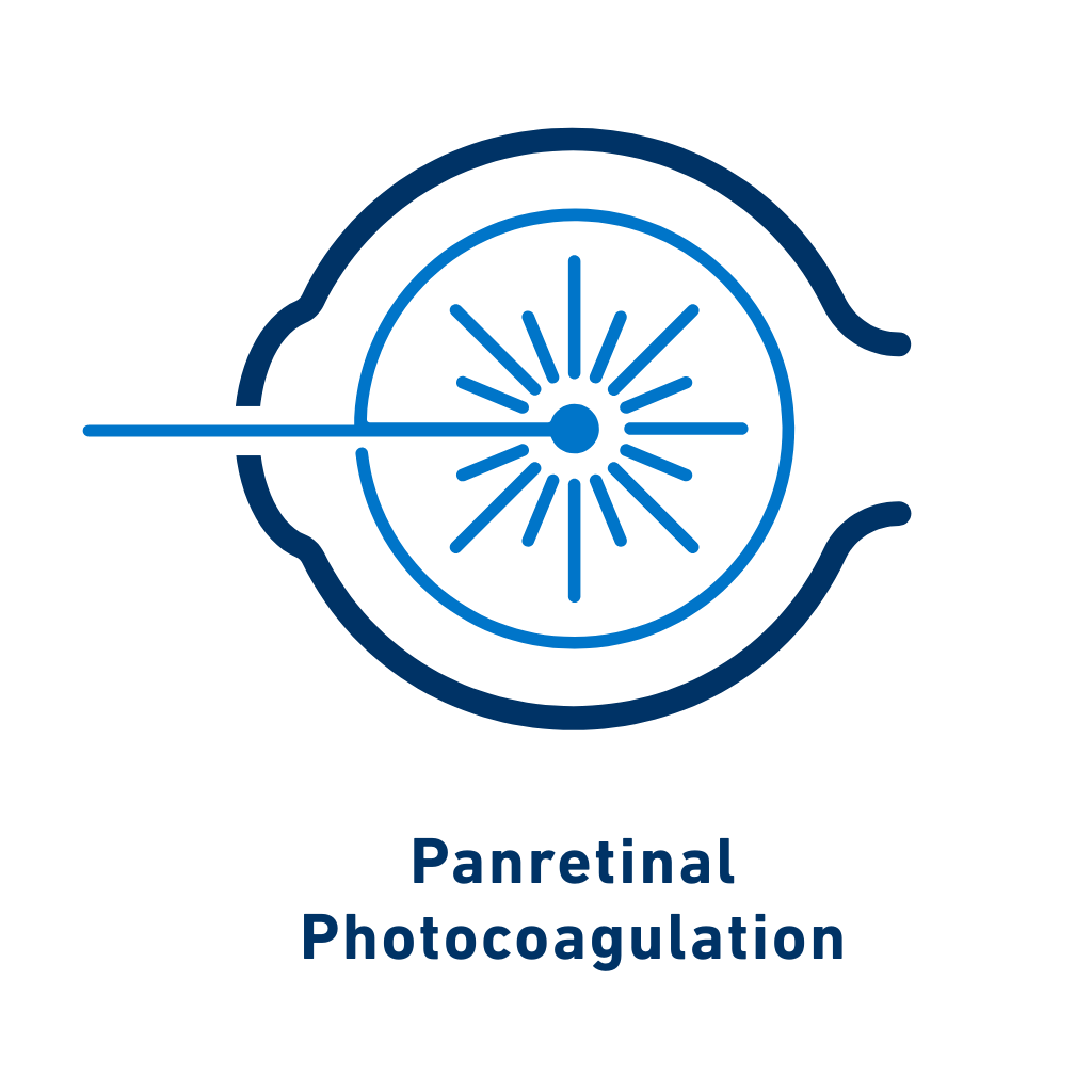 Panretinal Photocoagulation