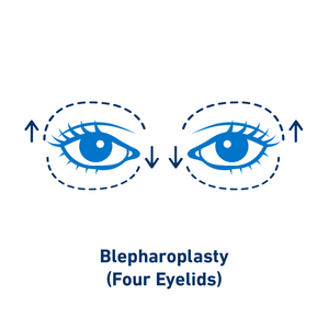 Blepharoplasty (Four Eyelids)