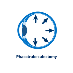Phacotrabeculectomy