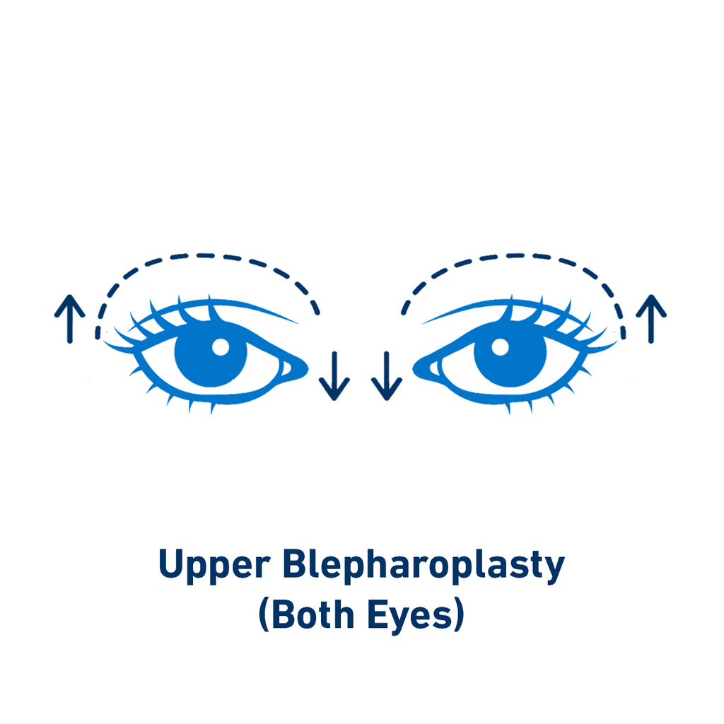 Upper Blepharoplasty (Both Eyes)