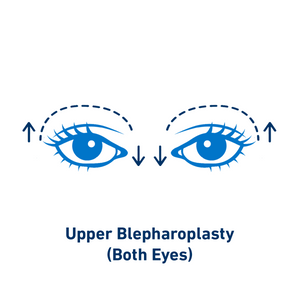 Upper Blepharoplasty (Both Eyes)