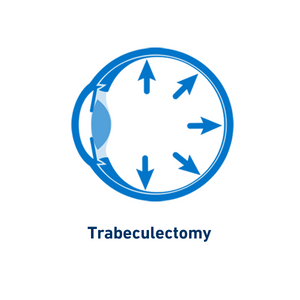 Trabeculectomy